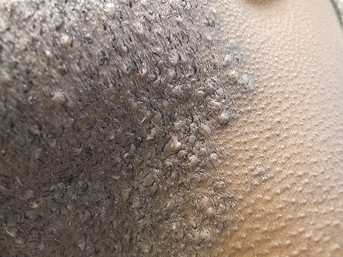 A 35-year-old man comes to the office due to painful bumps on his neck.  For the last 6 months, he has had a progressive rash on his anterior neck that has not improved with over-the-counter emollients.  Medical history is unremarkable.  Vital signs are within normal limits.  Skin examination findings are as shown:   The remainder of the examination is normal.  Which of the following is the most appropriate management for this patient's skin condition? A) Advise topical benzoyl peroxide B) Prescribe oral terbinafine C) Prescribe topical imiquimod D) Prescribe topical mupirocin E) Recommend discontinuation of shaving