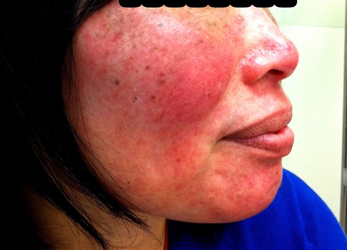 A 49-year-old woman comes to the physician requesting treatment for  this unattractive redness of my skin.   In the past 3 months, she developed blemishes on her nose, cheeks, and chin.  She now flushes intensely in response to hot or cold temperatures, emotion, and the consumption of spicy foods or alcohol.  She has no history of dermatological problems.  Physical examination shows a reddening of the central face, erythematous papules on the nose, and sporadic telangiectasias on the nose and cheeks as shown below.    Which of the following is the most appropriate treatment for this condition? A) Oral griseofulvin B) Topical clindamycin C) Topical clotrimazole D) Topical metronidazole E) Topical tretinoin