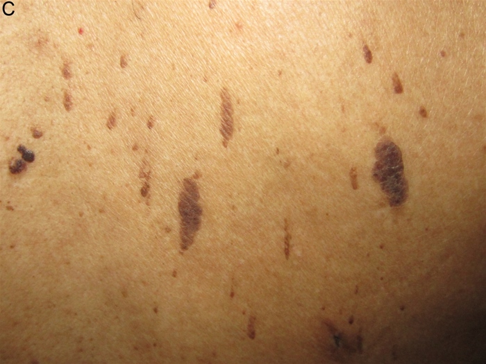 A 65-year-old woman comes to the office for evaluation of a rash.  The rash started nearly 3 years ago as a single lesion on her back, followed by multiple additional lesions in the same area and elsewhere on her trunk.  There is no associated pruritus.  The patient has a history of hypertension and gastroesophageal reflux disease.  Her medications include hydrochlorothiazide and omeprazole.  She has no history of tobacco or alcohol use.  Vital signs are within normal limits.  Skin examination findings are shown in the image below.  There is no warmth or tenderness around the lesions.  The remainder of her physical examination is normal.   Which of the following is the best next step in management of this patient? A) Cryotherapy B) Excisional biopsy C) Intralesional biopsy D) Reassurance E) Salicylic acid application