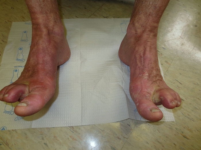A 52-year-old homeless man comes to the urgent care clinic due to itching and discomfort in both feet.  He has had these symptoms for the past year but they intensified recently.  His shoes are uncomfortable and cause irritation.  Several shelter residents also have some  swelling of the feet.   The patient was told that he has  borderline  diabetes and high blood pressure.  He has no regular medical follow-up.  Physical examination shows extensive erythema and scaling, especially between the toes, as well as multiple thickened and brittle toenails as shown in the image below.   Which of the following is the best treatment for this patient? A) Oral griseofulvin B) Oral terbinafine C) Topical hydrocortisone D) Topical nystatin E) Topical permethrin