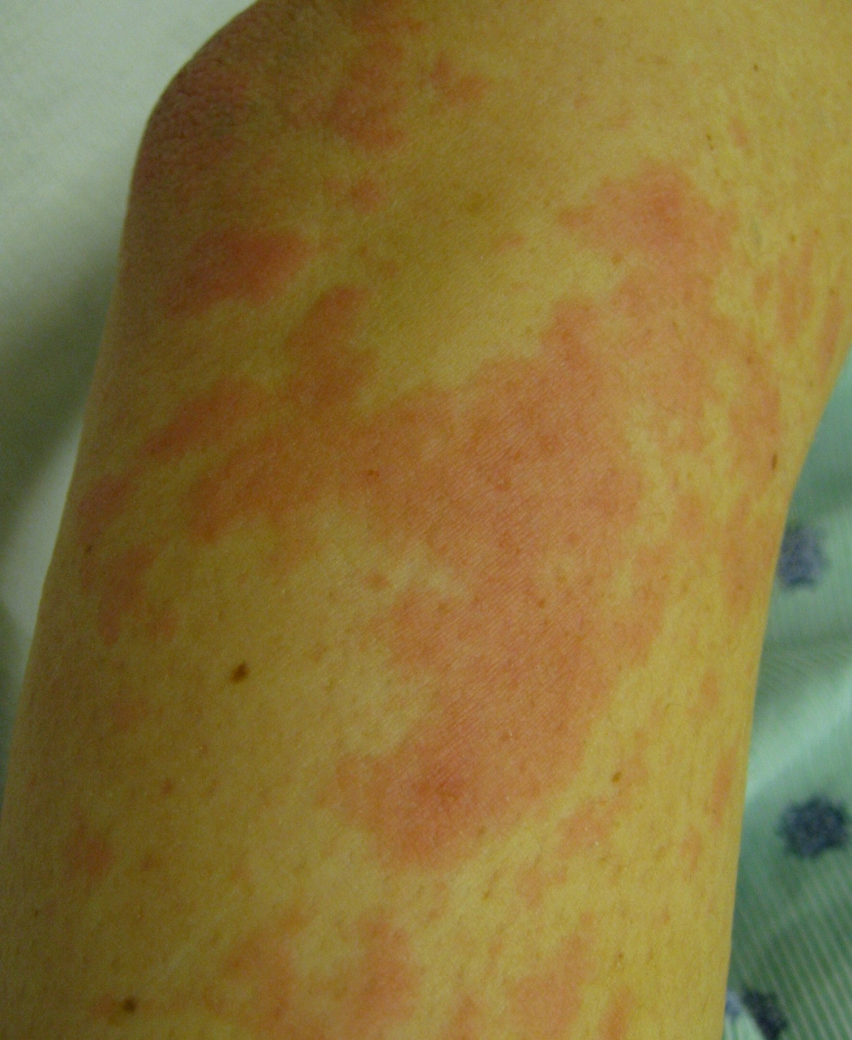 A 48-year-old woman comes to the office due to a recurrent rash.  Six months ago, a rash developed on her legs that she describes as  red patches with raised areas.   The rash worsened that night with intense itching that disrupted her sleep.  It spontaneously resolved over the next day.  Since then, she has had repeated episodes of similar symptoms on her arms, legs, and back, each lasting 8-12 hours and occurring nearly every 2-3 weeks.  She reports no trauma, insect bites, travel history, sick contacts, or changes in weight.  Medical history is notable for hypertension treated with lisinopril.  She does not use tobacco, alcohol, or illicit drugs.  Temperature is 36.1 C (97 F) , blood pressure is 138/77 mm Hg, and pulse is 78/min.  Physical examination is within normal limits.  The patient brings a photo of the rash, shown in the image below, from her most recent episode 2 days ago. Complete blood count, urinalysis, erythrocyte sedimentation rate, and liver function studies are within normal limits.   The patient currently has no rash but would like treatment recommendations for possible future episodes.  Which of the following is the most appropriate treatment for this patient? A) Daily cetirizine B) Daily hydroxyzine C) Daily montelukast D) Oral corticosteroids during episodes E) Topical corticosteroids during episodes