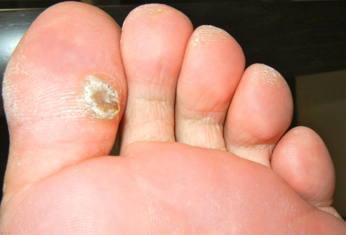A 47-year-old-man comes to the physician for a lesion on his foot.  He has a 2-month history of an enlarging, painful, and thickened papule on the plantar surface of his left great toe.  The patient attempted treatment for 2 weeks with a  corn pad  without relief.  He has no prior history of similar lesions, and his past medical history is unremarkable.   The patient returns in 10 days and has only partial improvement in the size of the lesion.  Which of the following is the most appropriate advice for this patient? A) Add topical imiquimod B) Consult with a dermatologist regarding additional options C) Continue the current treatment D) Discard and replace footwear E) Surgical excision