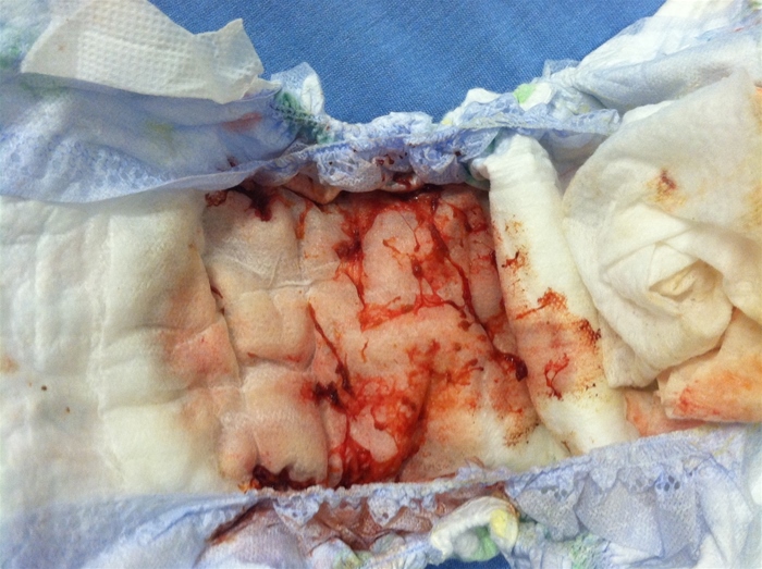A 2-year-old boy is brought to the emergency department by his grandmother due to abdominal pain and lethargy.  The grandmother reports that he was playing calmly last night when he suddenly began screaming and holding his abdomen.  The pain resolved after several minutes, but the patient has had 5 additional episodes of sudden-onset, severe pain since then.  Today, the grandmother notes that he has no interest in eating or drinking and has been  sleeping all day  but intermittently awakens in pain.  The patient has also had several episodes of nonbloody, nonbilious emesis and  fewer wet diapers than usual.   He has had no fever, diarrhea, or recent infections.  He is an otherwise healthy child with no prior hospitalizations or chronic medical conditions.  The patient takes no medications, and his immunizations are up to date.  Temperature is 37 C (98.6 F) , blood pressure is 90/56 mm Hg, pulse is 160/min, and respirations are 24/min.  During the examination, the boy is sleeping and arouses briefly.  The abdomen has hypoactive bowel sounds and diffuse mild tenderness to palpation.  He is circumcised, with both testes descended and with intact cremasteric reflexes.  Immediately after the examination, the child passes blood in his diaper, as shown in the image below.   The medical team has determined the appropriate procedure.  The patient lives with his parents and his grandmother about an hour away from the hospital.  His grandmother drove him to the emergency department but is not his legal guardian.  She states,  His mom should be on the way; she probably just left the house.   However, despite multiple attempts, the medical team is unable to reach either of the patient's parents by telephone.  Which of the following is the most appropriate next step in management of this patient? A) Delay the procedure until informed consent is obtained from both the mother and the father B) Delay the procedure until informed consent is obtained from either the mother or the father C) Proceed with the procedure after the grandmother provides informed consent D) Proceed with the procedure after the patient provides informed consent E) Proceed with the procedure without informed consent