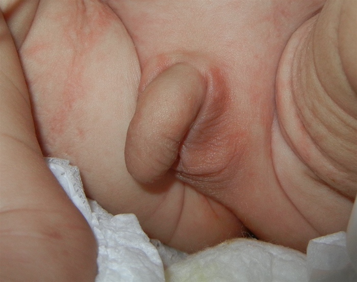 A 7-month-old boy is brought to the office for a routine visit.  The parents' only concern is that their son's  private area looks abnormal,  which his primary care provider has been monitoring.  He breastfeeds on demand and recently started eating pureed fruits and vegetables.  The infant urinates frequently and stools once a day.  He rolls in both directions, responds to his name, and transfers objects from one hand to the other.  The patient was born by cesarean delivery at 36 weeks gestation for maternal preeclampsia.  He was small for gestational age but has gained weight appropriately since birth.  Weight, length, and head circumference track along the 30th percentile.  Physical examination shows an interactive and alert infant.  The abdomen is soft, nontender, and nondistended.  Genital examination reveals a hypoplastic, hypopigmented, empty left scrotum (shown in the image below) .   A small mobile mass is palpable in the left inguinal canal.  The right testicle is palpated in the right hemiscrotum, which has normal cremasteric reflex and normal rugae.  The penis is uncircumcised, and the urethral meatus is at the tip of the glans.  Which of the following is the most appropriate next step in management of this patient? A) Order a karyotype analysis B) Order an abdominal ultrasound C) Reassure and continue observation D) Schedule the patient for an orchiopexy E) Surgically excise the mass