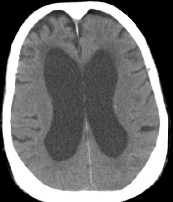 A 79-year-old man comes to the physician with his daughter for memory loss over the last 8-12 months.  She initially noticed that he had trouble with forgetfulness, followed by distractibility and difficulty with word finding and object recognition.  The patient is currently dependent on her for most independent activities of daily living, including transportation and finances.  He is able to dress, bathe, and toilet himself.  His gait has been unstable, and he sometimes seems to get  stuck in a chair.   On review of systems, he notes urinary urgency, frequency, and incontinence.  He has a history of benign prostatic hyperplasia for which he takes tamsulosin.  The patient has no tremor, problems with sleep, weakness, hallucinations, or sensory disturbances.  On examination, his vital signs are normal.  He is oriented to self only.  On mental status examination, he has impairments in language, visuospatial skills, and executive function.  His cranial nerves are intact.  There is normal bulk and tone of the musculature.  His gait is wide based and magnetic.  He has decreased stride length and a slow turn requiring several steps.  Laboratory results, including TSH and vitamin B12, are normal.  Brain imaging is shown in the image below.   Which of the following is the most appropriate next step in management of this patient? A) Acetazolamide B) Carbidopa-levodopa C) Donepezil D) Lumbar drainage of cerebrospinal fluid E) Ventriculoperitoneal shunting