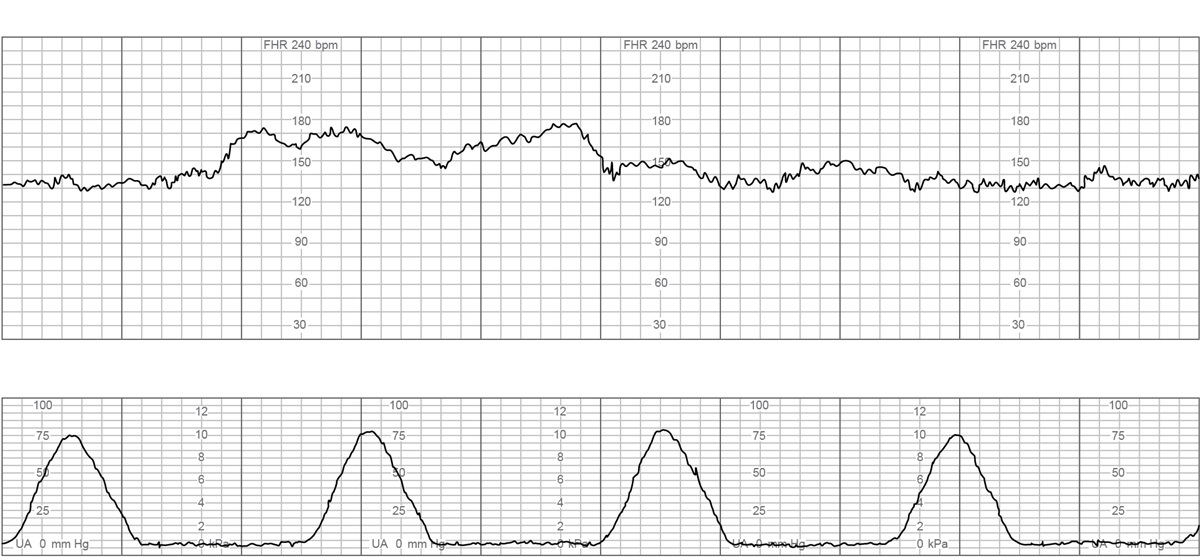 A 34-year-old woman, gravida 2 para 1, at 38 weeks gestation comes to the emergency department for contractions and vaginal spotting.  The contractions started 4 hours ago and are now occurring every 3 minutes.  She reports normal fetal movement and no leakage of fluid.  The patient had no prenatal care but was hospitalized at 18 weeks gestation for viral gastroenteritis.  A fetal ultrasound performed during this hospitalization was normal.  The patient's previous delivery, a year ago, was a term cesarean delivery for breech presentation.  The patient has no chronic medical conditions and has had no other surgeries.  She does not use tobacco, alcohol, or illicit drugs.  Temperature is 36.7 C (98 F) , blood pressure is 100/60 mm Hg, and pulse is 84/min.  The fetal heart rate tracing is shown below:   Examination shows the cervix to be 5 cm dilated and 80% effaced, with the fetal head at 0 station.  Blood type is O, Rh negative.  The patient is admitted and epidural anesthesia is administered.  Two hours later, the patient has spontaneous rupture of membranes and becomes acutely uncomfortable.  Blood pressure is 140/92 mm Hg and pulse is 100/min.  The fetal heart rate tracing now is shown below:   The patient begins to have heavy vaginal bleeding.  The cervix is now 5 cm dilated and 80% effaced, with the fetal head at -3 station.  Which of the following is the best next step in management of this patient? A) Increase epidural anesthesia and start amnioinfusion B) Perform emergency laparotomy C) Perform emergency operative vaginal delivery D) Place a fetal scalp electrode and continue labor E) Start magnesium infusion and give Rho(D)  immune globulin