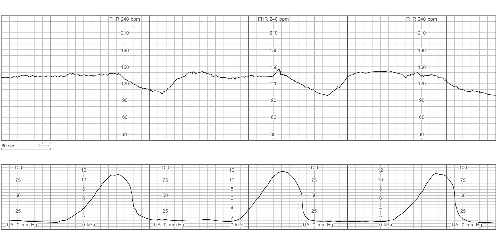 A 34-year-old woman, gravida 2 para 1, at 38 weeks gestation comes to the emergency department for contractions and vaginal spotting.  The contractions started 4 hours ago and are now occurring every 3 minutes.  She reports normal fetal movement and no leakage of fluid.  The patient had no prenatal care but was hospitalized at 18 weeks gestation for viral gastroenteritis.  A fetal ultrasound performed during this hospitalization was normal.  The patient's previous delivery, a year ago, was a term cesarean delivery for breech presentation.  The patient has no chronic medical conditions and has had no other surgeries.  She does not use tobacco, alcohol, or illicit drugs.  Temperature is 36.7 C (98 F) , blood pressure is 100/60 mm Hg, and pulse is 84/min.  The fetal heart rate tracing is shown below:   Examination shows the cervix to be 5 cm dilated and 80% effaced, with the fetal head at 0 station.  Blood type is O, Rh negative.  The patient is admitted and epidural anesthesia is administered.  Two hours later, the patient has spontaneous rupture of membranes and becomes acutely uncomfortable.  Blood pressure is 140/92 mm Hg and pulse is 100/min.  The fetal heart rate tracing now is shown below:   The patient begins to have heavy vaginal bleeding.  The cervix is now 5 cm dilated and 80% effaced, with the fetal head at -3 station.  Which of the following is the best next step in management of this patient? A) Increase epidural anesthesia and start amnioinfusion B) Perform emergency laparotomy C) Perform emergency operative vaginal delivery D) Place a fetal scalp electrode and continue labor E) Start magnesium infusion and give Rho(D)  immune globulin