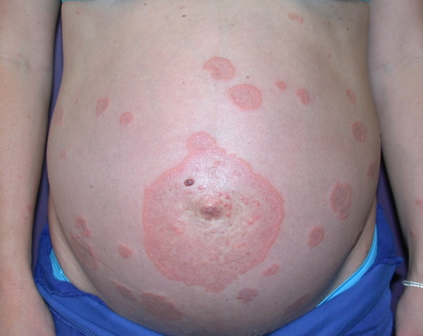 A 29-year-old woman, gravida 2 para 0 aborta 1, at 34 weeks gestation comes to the office for a routine prenatal visit.  She reports no abdominal pain, leakage of fluid, or vaginal bleeding.  There is normal fetal movement.  Since her last visit 2 weeks ago, she has developed severe pruritus on her abdomen, which has not responded to over-the-counter moisturizers.  The patient has had no recent contact with anyone who has had a fever, rash, or pruritus.  She was diagnosed with gestational diabetes mellitus that is well controlled with an insulin regimen.  Earlier in the pregnancy, she had an episode of vulvar candidiasis that was treated with a topical antifungal.  The patient has no chronic medical problems or previous surgeries.  She takes prenatal vitamins daily and has no allergies.  The patient does not use tobacco, alcohol, or illicit drugs.  Temperature is 36.7 C (98 F)  and blood pressure is 100/70 mm Hg.  BMI is 31 kg/m<sup>2</sup>.  Fetal heart rate is 145/min and fundal height is 35 cm.  Physical examination shows prominent abdominal striae and several red linear excoriations on the abdominal wall unrelated to the striae.  Laboratory results are as follows:   The patient is prescribed treatment for her symptoms.  She returns a week later for follow-up and reports good fetal movement and no contractions, vaginal bleeding, or leakage of fluid.  Her pruritus has worsened, and blisters have appeared near her umbilicus and are spread out over her abdomen.  Temperature is 36.7 C (98 F)  and blood pressure is 100/70 mm Hg.  Fetal heart rate is 145/min and fundal height is unchanged at 35 cm.  Physical examination reveals the following:   Which of the following is the most likely diagnosis?  A) Herpes simplex infection  B) Pemphigoid gestationis  C) Primary varicella infection  D) Pruritic folliculitis of pregnancy  E) Pustular psoriasis of pregnancy