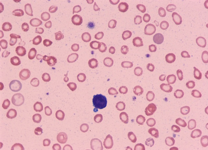 A 29-year-old Asian woman, gravida 1 para 0, comes to the office at 26 weeks gestation for prenatal care.  The patient has no abdominal pain, vaginal bleeding, or leakage of fluid.  Fetal movement is normal.  For the last few weeks, she has become increasingly fatigued and is sleeping at least 8 hours a night in addition to taking an afternoon nap.  Her pregnancy has been uncomplicated and initial prenatal laboratory results were as follows:   The patient has no chronic medical conditions and has had no previous surgeries.  She takes a daily prenatal vitamin; however, she was unable to begin taking it until 18 weeks gestation due to daily nausea and vomiting.  Blood pressure is 110/60 mm Hg and pulse is 64/min.  Weight is 60 kg (132.3 lb) , a 5-kg (11-lb)  increase from her prepregnancy weight.  Fetal heart rate is 145/min by Doppler ultrasound.  Fundal height is 26 cm.  Urine dipstick is negative for protein and glucose.  Routine third-trimester laboratory results include the following: The results of a peripheral blood smear are shown below:   The patient asks about the cause of her fatigue and whether she needs treatment.  Which of the following is the most appropriate response to this patient? A) The anemia is due to hemoglobinopathy and requires further evaluation with hemoglobin electrophoresis. B) The anemia is due to increased nutrient requirements during pregnancy and requires iron supplementation. C) The anemia is due to persistent vomiting in early pregnancy and requires vitamin B<sub>12</sub> supplementation. D) The anemia is due to physiologic changes of pregnancy, and no further treatment is indicated. E) The anemia is due to the lack of prenatal vitamins, and folic acid supplementation is indicated.