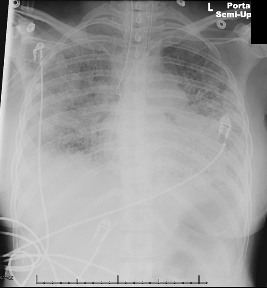 A 72-year-old woman is found to be severely short of breath at her skilled nursing facility.  The patient was recently hospitalized for vertebral osteomyelitis and discharged 2 weeks ago to complete a 6-week course of piperacillin-tazobactam via a peripherally inserted central venous catheter.  Her dyspnea began only with exertion but is now also present at rest.  Medical history includes coronary artery disease with ischemic cardiomyopathy, chronic obstructive pulmonary disease, and chronic kidney disease.  She has had 2 hospitalizations for heart failure over the last year; noninvasive positive-pressure ventilation was required.  Paramedics observe the patient to be obtunded with agonal respirations and rales throughout the bilateral lung fields.  Oxygen saturation is 72% on room air.  She is intubated and transferred to the emergency department.  On arrival, the patient is minimally responsive to stimuli.  Temperature is 36.7 C (98 F) , blood pressure is 115/65 mm Hg, and pulse is 110/min and regular.  The patient's oxygen saturation is 88% on 100% inspired oxygen.  BMI is 19 kg/m<sup>2</sup>.  The trachea is midline.  On physical examination, rales are heard on the right side and markedly decreased breath sounds on the left side of the chest.  S3 is heard.  There is 2+ bilateral peripheral edema.  A chest x-ray reveals the following:    Which of the following is the most appropriate next step in management of this patient? A) Insert a chest tube on the left side B) Obtain a chest CT scan with contrast C) Perform needle decompression on the left side of the chest D) Retract the endotracheal tube approximately 3-5 cm E) Start an infusion of dobutamine