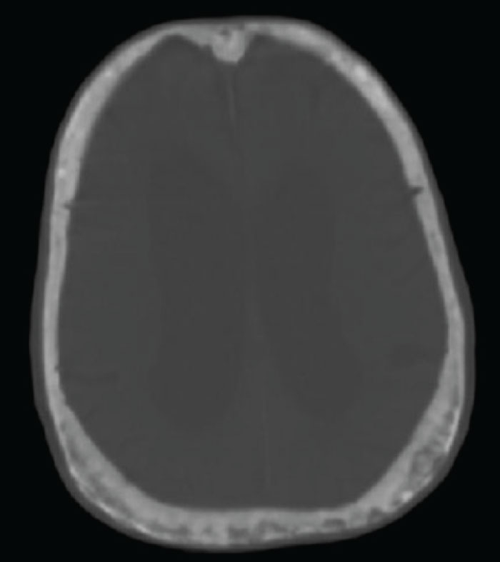 A 66-year-old man comes to a community clinic after undergoing a computed tomography scan of the head at a local emergency department.  He fell while stepping out of the bathtub and struck his head but did not lose consciousness.  The patient sustained a small head laceration that was closed with sutures, but no other injuries were identified in the emergency department.  He reports a longstanding history of normal-pressure hydrocephalus with frequent falls, but he has not followed up with his neurologist for several years.  The patient is now asymptomatic with no headaches, focal weakness, or dizziness.  His head computed tomography scan with bone windows is shown in the image below.    What is the best next step in management of this patient? A) Bone densitometry B) Calcium and vitamin D supplementation C) Echocardiogram and carotid ultrasound D) Serum calcium and alkaline phosphatase E) Serum protein electrophoresis