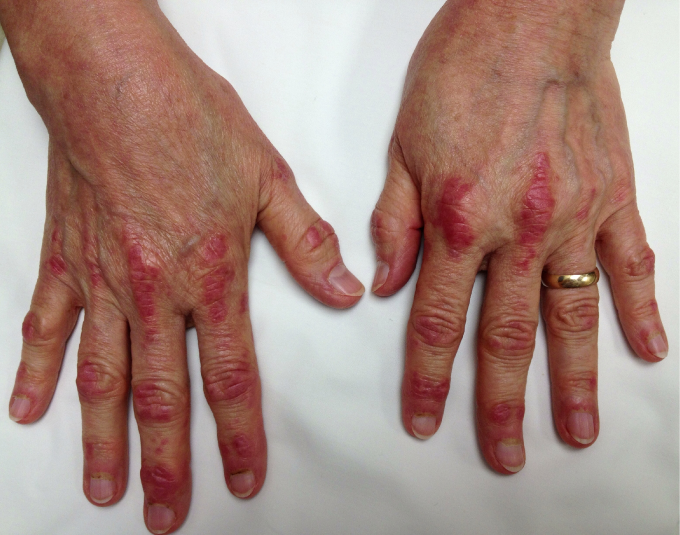 A 55-year-old woman comes to the physician due to a 2-month history of malaise, mild fever, and difficulty climbing stairs and rising from a chair.  She has unintentionally lost 9.1 kg (20.1 lb)  over this period.  The patient has hypertension and asthma.  Medications include amlodipine, as-needed albuterol, and inhaled glucocorticoids during winter.  The patient does not smoke or use illicit drugs.  She worked for 20 years supervising cotton processing in a textile factory but has been working as a secretary for the past 10 years.  Temperature is 37.8 C (100 F) , blood pressure is 120/70 mm Hg, pulse is 82/min, and respirations are 12/min.  Chest examination reveals clear lung fields and normal S1 and S2.  The patient has bilateral proximal upper and lower extremity weakness with normal reflexes.  Plantar reflexes are down-going bilaterally.  Violaceous papules and plaques are seen on the dorsum of both hands, as shown in the image below:   Kidney and liver function are within normal limits.  Creatine kinase level is 1,200 IU/L. Which of the following is the best next step in management of this patient? A) Muscle biopsy B) Serology for antibody testing C) Skin biopsy D) Termination of inhaled glucocorticoid therapy E) Test for HIV infection