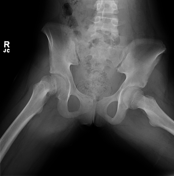 A 12-year-old boy is brought to the office by his father for an urgent care visit due to right hip pain that has worsened over the past 3 weeks.  The patient initially had  a little bit  of hip pain, but now the pain has spread to his thigh and knee.  He says,  It is so bad that I can barely walk.   The boy has had no recent injuries, fever, or sore throat.  Aside from the pain in the right lower extremity, he feels well.  He has mild eczema that is managed with emollients.  He is allergic to dust and cats.  The patient's only hospitalization was for an appendectomy at age 7.  Temperature is 37 C (98.6 F) , blood pressure is 114/74 mm Hg, and pulse is 90/min.  He is at the 95th percentile for weight and the 50th percentile for height.  Physical examination reveals an obese boy in moderate pain, with the right hip in an externally rotated position.  There is no warmth, swelling, or tenderness of the right knee or thigh.  The patient has normal Tanner 3 male external genitalia; the testes are descended bilaterally.  Sensation is intact in the lower extremities, and peripheral pulses are 2+ bilaterally.  Dry, red patches are present on the right knee and left elbow.  The remainder of the physical examination is normal.  X-ray of the hips is shown below.   Which of the following is the most appropriate next step in management of this patient's condition? A) Arthrocentesis of the right hip B) Bone scintigraphy C) External reduction and fixation with a cast D) Immediate surgical pinning E) Weight loss and analgesic therapy
