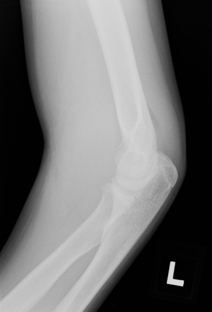 A 12-year-old boy is brought to the emergency department by his parents due to left arm pain.  He was competing in a basketball tournament and fell on his left arm while his left hand was outstretched and immediately experienced severe pain.  The patient has seasonal allergies for which he takes loratadine daily.  Immunizations are up to date.  Physical examination reveals a tearful and anxious boy in moderate distress.  There is significant swelling over the left elbow, and the patient has limited range of motion at the elbow secondary to pain.  He can fully extend and flex all 5 digits.  Radial pulse is palpable, and there is brisk capillary refill.  There is no tenderness to palpation over the wrist or forearm.  Radiograph of the elbow is shown below and reveals a displaced posterior fat pad in the olecranon fossa.  In addition to administration of pain medication, which of the following is the most appropriate next step in management of this patient?   A) Attempt manual reduction by flexion and supination B) Perform emergent fasciotomy C) Perform surgical reduction and internal fixation D) Place splint for immobilization E) Prescribe rest, application of ice, and elevation