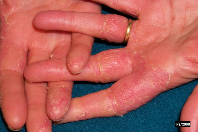 A 43-year-old woman comes to the physician for a rash on her hands.  The rash began 8-10 weeks ago.  She moved to the community approximately 4 months ago and works as a nurse in the dialysis unit at a nearby hospital.  The patient's past medical history is significant for hypertension treated with hydrochlorothiazide.  She also takes naproxen regularly for headaches.  Her hands are shown in the image below:   Which of the following is the most likely diagnosis? A) Contact dermatitis B) Phototoxic dermatitis C) Psoriasis D) Scabies E) Tinea manuum