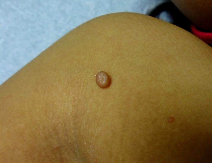 A 23-year-old woman comes to the physician with skin lesions.  She noticed a small papule 2 weeks ago and now has additional similar lesions.  There is no associated pain.  The patient has had no systemic symptoms except 1 day of diarrhea that resolved 3 weeks ago.  She has no previous medical problems and works as an assistant at a veterinary facility.  The patient has been sexually active with a new partner.  She drinks alcohol socially, but does not use tobacco or illicit drugs.  Her vital signs are normal.  Physical examination is normal except for the lesions as shown below.   Which of the following is the most likely cause of her skin lesions? A) Autoimmune condition B) Fungal infection C) Insulin resistance D) Occupational exposure E) Skin-to-skin contact