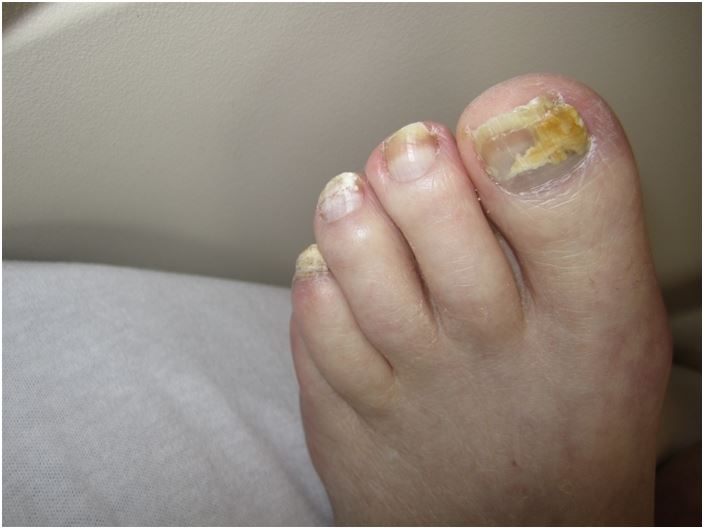 A 64-year-old woman comes to the physician due to thickening and discoloration of her toenails.  Her nails are rough, and this is starting to cause pain and making it difficult to wear shoes with socks.  A few months ago, she first noticed that the big toes of both feet were affected, subsequently several other nails became affected as well.  On physical examination, the affected nails appear rough, brittle, and discolored as shown in the image below.  Potassium hydroxide preparation of nail scrapings shows dermatophytic hyphae and arthrospores.   Which of the following is the most effective treatment regimen for this patient's condition? A) Ciclopirox B) Fluconazole C) Griseofulvin D) Ketoconazole E) Terbinafine
