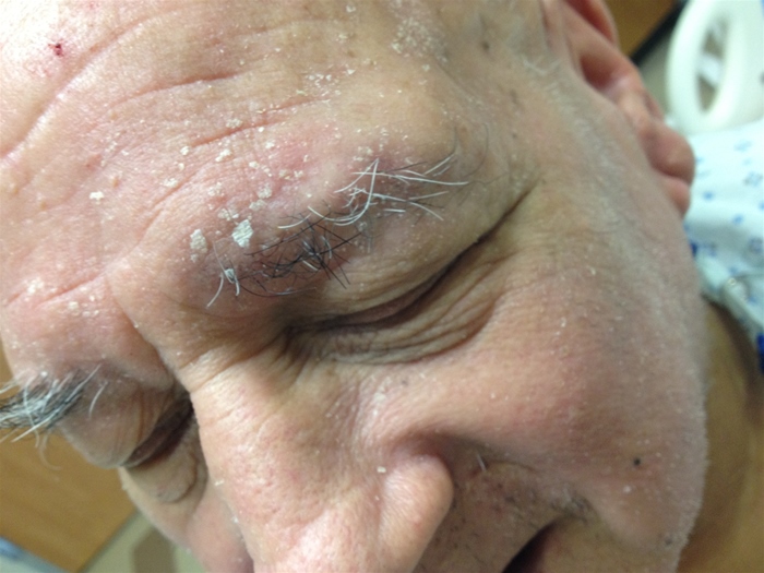 A 62-year-old man comes to the community health center due to a  flaky and itchy  scalp.  He is uncertain when the symptoms began and believes his brother has a similar problem.  The patient has not attempted any specific treatments but washes his hair with a mild shampoo every other day and washes his face with cold water once daily.  Medical history is notable for coronary artery disease, type 2 diabetes mellitus, benign prostatic hyperplasia, and diverticulosis.  The patient is a recovering alcoholic and has lived in a group home for the last 3 months.  Vital signs are normal.  Physical examination shows oily skin with faint erythema and scaling of the scalp, eyebrows, and ears, as shown below.  During the course of the visit, the patient repeatedly scratches his head and eyebrows, but the remainder of the skin examination is normal.    Which of the following is the best initial treatment for this patient? A) Oral griseofulvin B) Oral ketoconazole C) Permethrin cream D) Selenium sulfide shampoo E) Topical nystatin