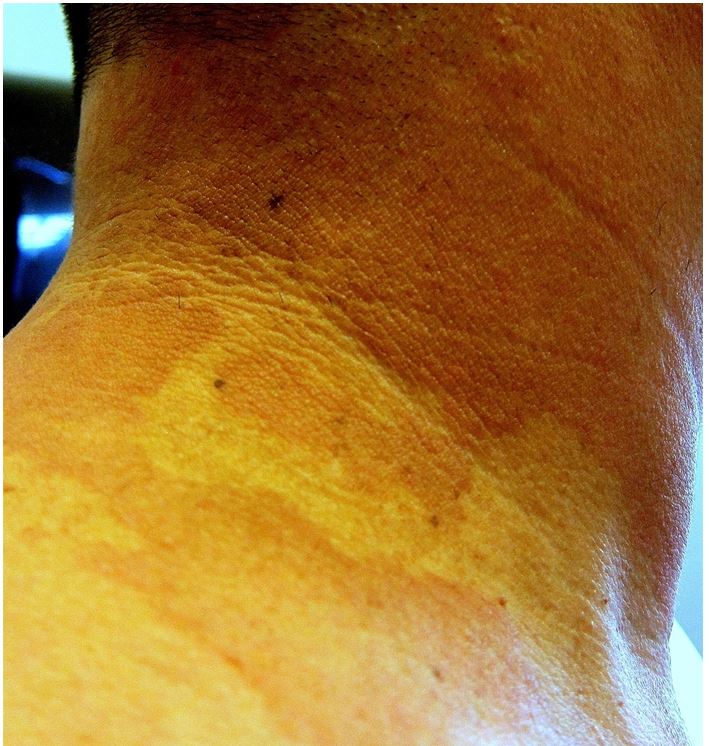 A 41-year-old man comes to the physician with a faint skin rash over his upper body.  He first noticed it in the spring season, but it worsened during the summer.  The patient has mild itching, but otherwise the rash is asymptomatic.  He takes omeprazole for acid reflux but his medical history is otherwise unremarkable.  He does not use tobacco, alcohol, or illicit drugs.  The patient has been sexually active with 2 partners during the last year, and uses condoms on most occasions.  The physical examination findings are shown below.   Which of the following is the best treatment for this patient? A) Intramuscular penicillin B) Oral erythromycin C) Oral griseofulvin D) Topical corticosteroids E) Topical ketoconazole
