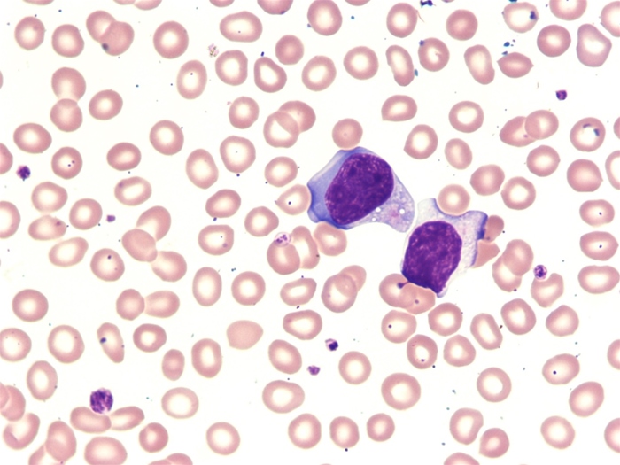 A 15-year-old boy is brought to the office due to fever.  He has had fever, chills, fatigue, and myalgias for the past 10 days.  He has lost some weight, which was attributed to poor appetite.  Three weeks ago, the patient and his family returned from a trip to the Dominican Republic; he has not traveled anywhere else.  There are no sick contacts at home.  The patient has no significant medical history and takes no medications.  Temperature is 38.3 C (101 F) , blood pressure is 110/60 mm Hg, and pulse is 108/min.  Physical examination shows a tired-looking boy in no acute distress.  The tympanic membranes are not erythematous; mucous membranes are moist; and tonsils are enlarged and erythematous with white exudate.  S1 and S2 are normal without murmurs.  The lungs are clear to auscultation bilaterally.  Lymphadenopathy is present in the anterior cervical, posterior cervical, axillary, and inguinal chains.  The abdomen is soft and nontender.  Laboratory results are as follows:   The peripheral blood smear is shown in the image:   What is the most likely reason for these findings? A) Hematologic malignancy B) Lymphoproliferative malignancy C) Parasitic infection D) Systemic bacterial infection E) Systemic viral infection