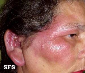 A 45-year-old female presents to your office with fever, malaise and facial rash.  The symptoms started acutely one day ago, and she took two tablets of ibuprofen to relieve the fever.  Her past medical history is insignificant.  She works as a clerk at a private office, and is not physically active.  She smokes two packs of cigarettes daily, and consumes alcohol occasionally.  She denies any recreational drug use.  She has no known allergies.  She is sexually active in a monogamous relationship with her husband.  The rash is shown below.    Other physical findings are within normal limits.  Which of the following is the most likely cause of this patient's problem? A) Hemophilus influenzae B) Staphylococcus aureus C) Group-A streptococcus D) Neisseria meningitidis E) Herpes simplex virus (HSV) 