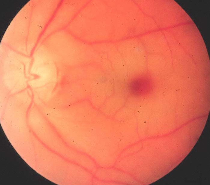 A 50-year-old woman with type 2 diabetes mellitus, hypertension, and obesity comes to the emergency department with left-sided vision loss that started 45 minutes ago.  She has no fever, headache, eye pain, or tearing.  On examination, she can only see hand motion with her left eye and cannot count fingers.  Visual acuity in the right eye is normal.  Funduscopic findings are shown below.   Which of the following is the most likely cause of this patient's condition? A) Central retinal artery occlusion B) Increased intracranial pressure C) Increased intraocular pressure D) Optic neuritis E) Proliferative retinopathy