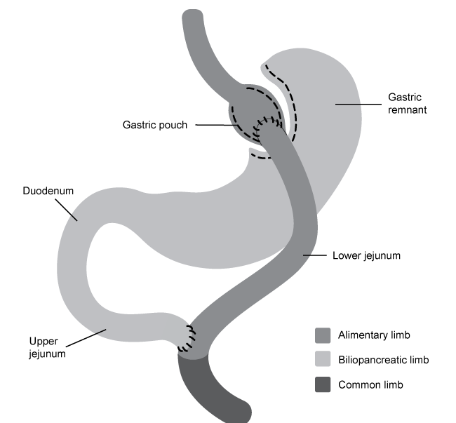 Passage Obesity is a condition that affects over 30% of adults in the United States and is associated with comorbidities such as type 2 diabetes mellitus, heart disease, and cancer.  For individuals with clinically severe obesity, defined as having a body mass index above 40 kg/m<sup>2</sup>, lifestyle interventions may produce insufficient weight reduction.  Weight loss surgery, such as Roux-en-Y gastric bypass (RYGB) , has proved to be the most effective clinical intervention for facilitating massive and immediate weight loss in clinically obese patients.In RYGB, the stomach is first divided into a small gastric pouch and a distal gastric remnant, which remains attached to the duodenum.  Next, the jejunum is transected and its lower section is connected to the newly created gastric pouch to form the alimentary limb.  This connection is typically created with surgical staples.  The formation of the alimentary limb allows ingested food to bypass the region composed of the distal gastric remnant, the duodenum, and the upper jejunum; collectively termed the biliopancreatic limb.  Finally, the lumen of the upper jejunum is reconnected to the lumen of the lower jejunum to allow enzymes and compounds to flow freely from the biliopancreatic limb into the alimentary limb.    <strong>Figure 1</strong>  RYGB surgically divides the digestive tract into the alimentary limb and the biliopancreatic limb, which then merge into the common limb.RYGB facilitates weight loss by reducing the functional volume of the stomach and altering intestinal anatomy to induce nutrient malabsorption.  However, the procedure is associated with several complications, such as steatorrhea, or fatty stools, due to disruption of lipid digestion.  Animal studies also suggest that RYGB promotes the growth of weight loss-inducing gut bacteria.  Researchers have found that transplanting gut microbiota of obese postoperative RYGB mice into nonoperated, obese mice lacking gut flora may reproduce the therapeutic effects of RYGB in transplant-recipient mice. Adapted from Bächler T, Le roux CW, Bueter M. How do patients' clinical phenotype and the physiological mechanisms of the operations impact the choice of bariatric procedure?. Clin Exp Gastroenterol. 2016;9:181-9. -In RYGB patients, ingested food will NOT pass through the: A) cardiac sphincter. B) intestinal villi. C) pyloric sphincter. D) cecum.