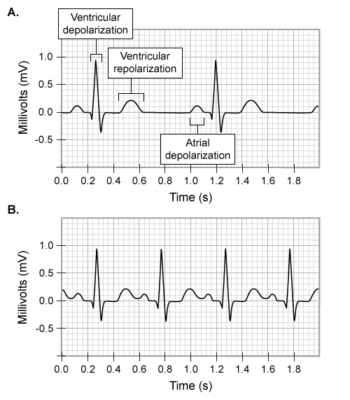 Passage The heart is a muscular organ comprising four chambers, two atria and two ventricles, that function synergistically to pump blood through a vast, closed network of blood vessels.  The chambers are separated by membranous muscular barriers known as septa.  Oxygenated blood returning from the lungs via the pulmonary veins fills the left atrium and enters the left ventricle, which then pumps the blood into the systemic arteries to supply other organs in the body.  By contrast, deoxygenated blood returning from systemic veins first enters the right atrium, then the right ventricle, and is ultimately siphoned into the pulmonary arteries leading to the lungs.  The necessary oxygen, nutrient, and waste exchange occurs between the thinnest blood vessels (capillaries)  and neighboring tissues of the systemic and pulmonary circuits.Blood flow throughout the circulatory system is dictated by blood (hydrostatic)  pressure, vascular resistance (force opposing blood flow through a vessel) , and cardiac output (blood volume expelled from the ventricles per unit time) .  When blood traverses a vessel, it exerts hydrostatic pressure on the vessel walls, which results in the forced movement of fluid out of the vessel and into the interstitial space.  The circulating plasma proteins cause the osmotic pressure within the vessel to be higher than that of the interstitial fluid.  In turn, osmotic pressure causes fluid to flow from the interstitial space into the blood vessel, opposing hydrostatic pressure.Cardiac output depends in part on heart rate, which is tightly regulated by the sinoatrial (SA)  and atrioventricular (AV)  nodes, specialized groups of self-depolarizing cells located in the upper right atrial wall and lower interatrial septum, respectively.  Action potentials (APs)  generated by SA nodal cells stimulate atrial contraction as they travel to the AV node.  The AV node delays AP transmission to ventricular cells, ensuring ventricular filling is complete prior to heart contraction.A 63-year-old male patient collapsed while exercising and was hospitalized.  The patient presented with an elevated heart rate, low systemic blood pressure, and abnormally low blood oxygen levels.  In addition, x-rays revealed excess fluid in his lungs. -The attending physician orders an electrocardiogram (ECG)  to measure the electrical activity of the patient's heart.  The results of the ECG of a healthy individual at rest (A)  and the ECG of the patient at rest (B)  are shown below.   Which of the following conclusions regarding the patient's cardiac function is best supported by these results? A) Atrial contraction occurs less frequently in the patient than in the healthy individual. B) APs are fired less frequently from AV nodal cells in the patient than in the healthy individual. C) Ventricular depolarization occurs for a longer time period in the patient than in the healthy individual. D) Influx of positive ions into SA nodal cells occurs more rapidly in the patient than in the healthy individual.