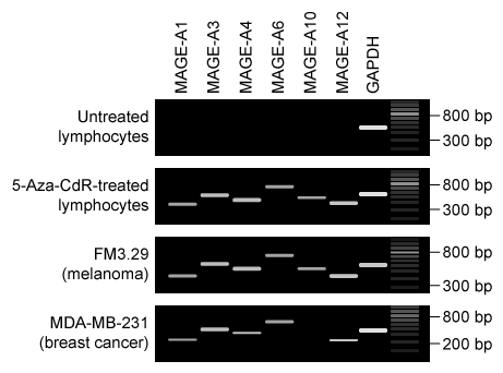 Passage Proteins known as cancer/testis antigens (CTAs)  are normally expressed exclusively in germline cells but may become reactivated in cancer cells due to chromatin remodeling (eg, gene activation due to DNA demethylation) .  Because of their normally restricted expression, CTAs can elicit an immune response when expressed by cancer cells derived from other tissue types.  Several CTAs are known to inhibit apoptosis or promote cell division in cancer cells, making them more resistant to traditional chemotherapy.  Accordingly, cancer research instead has focused on immunotherapy treatments targeting CTAs.In a study, researchers isolated peripheral blood lymphocytes (B lymphocytes, T lymphocytes, natural killer [NK] cells)  from two healthy individuals.  These lymphocytes were cultured with signaling factors known to promote helper T cell (T<sub>h</sub> cell)  proliferation.  After 7 days, cultures from both individuals were enriched for T<sub>h</sub> cells, which expressed proteins generally involved in activating other lymphocytes.  A subset of the cultures from each individual was treated with 5-Aza-CdR, a DNA-demethylating agent.  Reverse transcription polymerase chain reaction (RT-PCR)  was used to analyze expression of several CTAs (ie, MAGEs)  in both untreated and 5-Aza-CdR-treated lymphocyte cultures, as well as in untreated melanoma (skin cancer)  and breast cancer cell lines (Figure 1) .  GAPDH, a protein expressed in most cell types, served as a control.    <strong>Figure 1</strong>  Gels showing RT-PCR results for MAGE expressionAdditional peripheral blood lymphocytes were isolated from the same healthy individuals and incubated with the T<sub>h</sub> cells that had been treated with 5-Aza-CdR.  After 11 days, these cultures consisted primarily of an increased number of NK cells and cytotoxic T lymphocytes (CTLs) .  Researchers found that these CTLs were able to induce apoptosis in breast cancer cell lines but did not affect healthy cells.Researchers used a similar procedure to induce CTL proliferation in lymphocytes isolated from a breast cancer patient.  The CTLs were then incubated with cells obtained from a biopsy of the patient's cancerous tissue.  Following this experiment, researchers found that apoptosis was induced in the patient's cancer cells. Kirkin et al. Adoptive cancer immunotherapy using DNA-demethylated T helper cells as antigen-presenting cells. Nature Communications. 2018; 9:785 -Which of the following conclusions is best supported by the results presented in Figure 1? A) MAGE mRNAs are all composed of the same number of nucleotides. B) MAGE protein classes targeted by immune cells will differ depending on the cancer cell type. C) MAGE-A6 exhibits the highest level of expression in cancer cells. D) MAGE proteins are more active in breast cancer cells than in melanoma cells.
