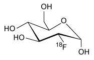 Passage The radiopharmaceutical 2-deoxy-2-(<sup>18</sup>F) fluoro-D-glucose (abbreviated as <sup>18</sup>F-FDG) is a modified form of D-glucose in which the hydroxyl group on the 2-carbon of the molecule has been replaced with a positron-emitting <sup>18</sup>F radionuclide. Synthesis of <sup>18</sup>F-FDG is accomplished in several steps involving both nuclear and chemical reactions, as shown in Figure 1. <strong>Figure 1</strong> Synthetic scheme for 2-deoxy-2-(<sup>18</sup>F) fluoro-D-glucoseInitially, a target of <sup>18</sup>O-enriched water (<sup>18</sup>OH<sub>2</sub>) is bombarded by protons using a cyclotron to achieve a (p-n) nuclear reaction in which a proton hitting the <sup>18</sup>O nucleus is absorbed by the nucleus, causing the ejection of a neutron and forming an <sup>18</sup>F nucleus. Following separation of the resulting <sup>18</sup>F<sup>−</sup> anions from the residual <sup>18</sup>OH<sub>2</sub> via an ion exchange column, <sup>18</sup>F<sup>−</sup> is used in a nucleophilic substitution reaction with an acetylated mannose triflate substrate. Subsequent hydrolysis to remove the acetyl protecting groups yields <sup>18</sup>F-FDG.Because <sup>18</sup>F-FDG is an analog of D-glucose, it is readily taken into cells by the same metabolic processes as D-glucose. Once inside the cells, the positron emissions of the <sup>18</sup>F radionuclide can be detected by positron emission tomography (PET) scans to produce diagnostic medical images of objects such as tumors. Emissions from the <sup>18</sup>F radionuclide subsequently diminish over time via radioactive decay (Figure 2) . <strong>Figure 2</strong> Nuclear decay of the <sup>18</sup>F radionuclideBecause of limitations in the spatial resolution of PET scanners, when an object (such as a tumor) is smaller than 30 mm in diameter, the measured specific uptake value (SUV) of <sup>18</sup>F-FDG accumulated within the object is lower than the actual SUV. The recovery coefficient (the ratio of the measured SUV to the actual SUV) shows that the measured SUV decreases as the size of the object decreases below the 30-mm threshold (Figure 3) . <strong>Figure 3</strong> Recovery coefficient as a function of object size in a PET scan with a spatial resolution of 7 mm using ordered subsets expectation maximization (OSEM) image processing Adapted from: S. Yu. Review of F-FDG Synthesis and Quality Control. Biomed Imaging Interv J. ©2006 Department of Biomedical Imaging, Faculty of Medicine, University of Malaysa; and P. E. Kinahan, et al., Positron emission tomography-computed tomography standardized uptake values in clinical practice and assessing response to therapy. Semin Ultrasound CT MR. ©2010 Elsevier. -Which of the following products is formed from <sup>18</sup>F-FDG following a positron emission? (Note: Assume any anions produced acquire hydrogen ions from the aqueous physiological environment.) A) B) C) D)
