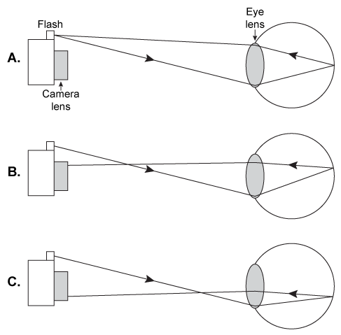 Passage For a person with perfect vision, light from an object is properly refracted by the eye lens to converge on a single point at the retina, forming a clear image of the object.  Vision defects result from eye shape abnormalities or errors in the refractive power of the eye lens.  Myopia (nearsightedness)  occurs when light from a distant object is incorrectly focused in front of the retina.  Hyperopia (farsightedness)  occurs when light rays from a nearby object are focused beyond the retina.Many optical techniques are available to measure the refractive error of an individual to determine the necessary correction.  Photorefraction is a photographic technique often used with young children because it does not require the individual to be still for a lengthy duration.  When the patient is looking at the camera, a flash photograph is taken of the eye to determine the amount of light that is reflected off the retina and captured by the camera lens.In healthy eyes, all the light from the flash that enters the eye is reflected off the retina and returns back to the camera's light source.  Because the camera lens does not receive this light, the pupil is completely dark in the resulting image.  A myopic eye cannot properly focus the light at the retina.  Due to the geometry of the eye and its lens, some of the light is reflected to the top portion of the camera lens.  The camera captures an image of a pupil with a crescent of light at the top.  In a hyperopic eye, the crescent appears at the bottom of the pupil.  Ray diagrams for photorefraction are shown in Figure 1.    <strong>Figure 1</strong>  Paths of light in photorefraction for different eyes:  (A)  Healthy, (B)  Myopic, and (C)  Hyperopic. HC. Howland,  Optics of photorefraction: orthogonal and isotropic methods.  ©1983 Optical Society of America. -A patient's eye lens has a focal length of 2 cm.  When the patient wears a pair of prescription eyeglasses with an optical power of −4 D, the combined strength of the lenses is approximately: A) 42 D B) 46 D C) 50 D D) 54 D