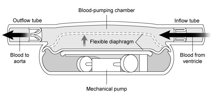 Passage In the event of end-stage heart failure, a left ventricular assist device (LVAD)  can be used as a heart transplant bridge to keep a patient alive.  The first iterations of LVADs were pulsatile and mimicked the physiological pumping action of the heart (Figure 1) .    <strong>Figure 1</strong>  A pulsatile-flow LVAD schematicA pulsatile-flow LVAD assists ventricular systole by mechanically pumping blood from a weakened left ventricle into the aorta through a pair of one-way valves.  The pressure differential ΔP generated by the pump is related to cardiac output (CO)  and vascular resistance (VR) :ΔP = CO × VR<strong>Equation 1</strong>The efficiency and performance of the heart (or LVAD)  can be determined by the patient's cardiac pressure-volume (PV)  loop.  A cardiac PV loop plots the pressure and volume of the blood in the left ventricle throughout a single cardiac cycle (Figure 2) .    <strong>Figure 2</strong>  Cardiac PV Loop of a pulsatile-flow LVADBlood pressure is often represented by only two numbers:  arterial systolic and diastolic pressures.  A more detailed representation of blood pressures is shown in a blood pressure profile, which graphs the blood pressure throughout the length of the different vessel groups (Figure 3) .  Multiple pressure fluctuations are shown within a vessel because the pressure is traced across multiple cardiac cycles.    <strong>Figure 3</strong>  Blood pressure profile of the different vessels -  In the above figure, an LVAD pump is placed at one end of a  U -shaped container, and a force gauge is placed at the other end.  If the container is filled with an incompressible fluid, what is the ratio of the force measured by the force gauge to the force exerted by the LVAD? A) 1:4 B) 1:2 C) 1:1 D) 4:1