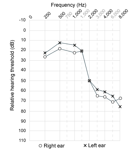 Passage Sound waves propagate through many conducting structures in the ear before they are transduced into neuronal signals.  When sound waves reach the fluid-filled cochlea, they are detected by hair cells lining the basilar membrane.  The cochlear spiral can be modeled as a resonator system because each section of the basilar membrane is sensitive to a specific frequency (Figure 1) .    <strong>Figure 1</strong>  Amplitude pattern of the basilar membrane for different frequenciesPresbycusis (age-related hearing loss)  results from a combination of factors that lessens an individual's mechanical and/or neurological sensitivity to sound.  Pure tone audiometry (PTA)  is used to determine an individual's ability to detect different sound frequencies and can be used to evaluate presbycusis.  A  pure  tone is characterized by a single sinusoidal waveform.  An audiogram plots the relative intensity required of a given frequency to be detected by the individual (Figure 2) .    <strong>Figure 2</strong>  Audiogram of an elderly patient exhibiting presbycusis -In Figure 2, how does the hearing threshold intensity at 1,500 Hz compare to the threshold intensity at 2,000 Hz? A) It is 30 times less intense. B) It is 30 times more intense. C) It is 1,000 times less intense. D) It is 1,000 times more intense.