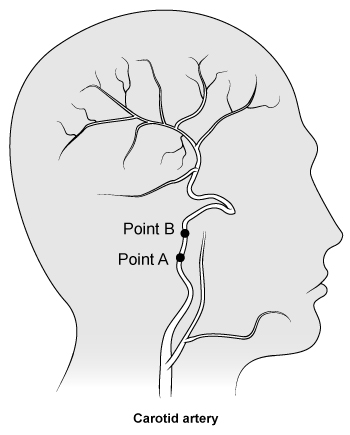 Blood flows from Point A to Point B at an initial velocity of 100 cm/s within an artery supplying the brain.  Assume negligible blood pressure change as the blood ascends 1 cm in the head.   What is the velocity of blood flow when the blood reaches Point B?  (Note: The density of blood is 1,060 kg/m<sup>3</sup>.)  A) 65 cm/s B) 90 cm/s C) 100 cm/s D) 115 cm/s