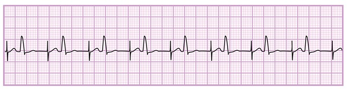 The telemetry nurse is reviewing a client's cardiac rhythm strip.  What is the correct interpretation for this strip?   A) Atrial paced rhythm B) First-degree atrioventricular block with bigeminy C) Sinus rhythm with premature ventricular contractions D) Ventricular paced rhythm with failure to sense