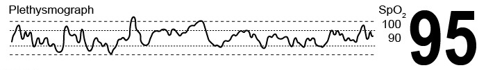The nurse is caring for a ventilator-dependent client with neuromuscular degenerative disease and observes the plethysmograph waveform in the image below.  What is the nurse's <strong>immediate</strong> action?   A) Assess level of consciousness, skin temperature, and color B) Disconnect pulse oximeter device from the client and restart it C) Preoxygenate with 100% oxygen and perform endotracheal suction D) Reset the high and low alarm parameters on the pulse oximeter device