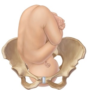 The nurse is admitting a pregnant client who is experiencing intense back labor. The nurse suspects the fetus is in which position? A) B) C) D)