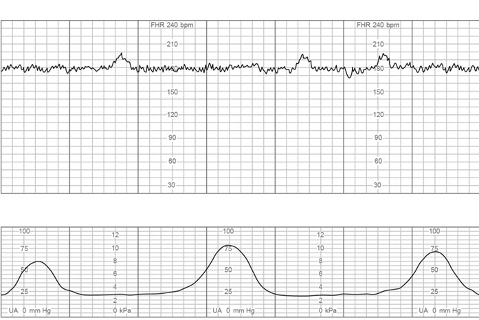 The charge nurse is observing fetal heart rate (FHR) tracings of 4 clients who have just been admitted to labor and delivery triage. Which FHR pattern would be <strong>most</strong> concerning to the nurse? A) B) C) D)