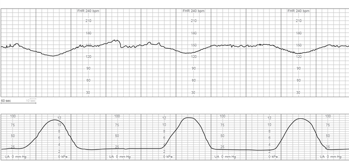 The charge nurse is observing fetal heart rate (FHR) tracings of 4 clients who have just been admitted to labor and delivery triage. Which FHR pattern would be <strong>most</strong> concerning to the nurse? A) B) C) D)