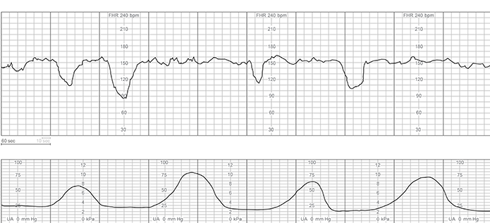 The charge nurse is observing fetal heart rate (FHR) tracings of 4 clients who have just been admitted to labor and delivery triage. Which FHR pattern would be <strong>most</strong> concerning to the nurse? A) B) C) D)
