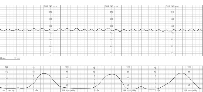 The charge nurse is observing fetal heart rate (FHR) tracings of 4 clients who have just been admitted to labor and delivery triage. Which FHR pattern would be <strong>most</strong> concerning to the nurse? A) B) C) D)
