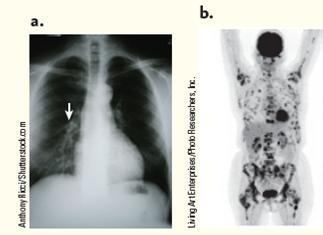 Your aunt tells you that she has just been diagnosed with lung cancer. The oncologist has two images: a chest X-ray film showing a tumor in the left lung (arrow) and a PET scan, which highlights specific areas (in black) where tumors are located ( Fig. ). Considering surgery, radiation therapy, and chemotherapy, what treatment option would you recommend to your aunt given the information you have? Choose any of these treatments that you believe apply and provide support for your choice(s). Figure Lung cancer test results. (a) X-ray film. (b) PET scan.