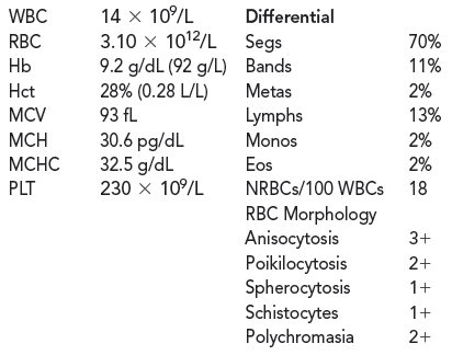 Stephen, a 28-year-old Caucasian male of Italian descent, became progressively ill following a safari vacation to West Africa. The patient arrived at the emergency room (ER) for evaluation following several days of fever, chills, and malaise. The advent of hemoglobinuria prompted the patient to seek emergency aid. A clinical history and physical examination supported a diagnosis of anemia. Because Stephen had recently returned from a malarial endemic area, the physician first suspected malaria although the patient had been on primaquine preventive drug therapy while traveling abroad. Blood smears examined for malaria, however, resulted in a negative diagnosis.  Consider what additional laboratory tests could help identify the cause of Stephen's anemia.  In addition to malaria screening, the ER physician also ordered a CBC with the following results:    Stephen was admitted for identification and treatment of the anemia. More lab tests were ordered with the following results:    Stephen's haptoglobin level is 25 mg/dL. Explain why he has a low haptoglobin value.