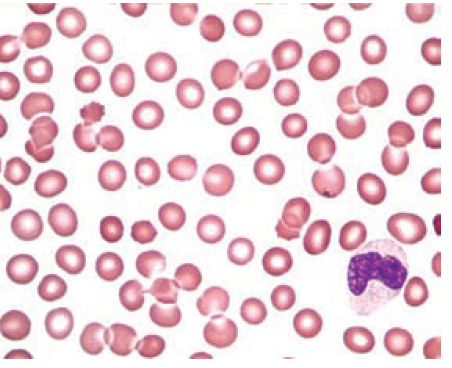 A 48-year-old woman was admitted to a hospital because of wheezing, cough, fatigue, and difficulty breathing. Her history included diabetes and hypertension. Her CBC data show a hemoglobin of 8.2 g/dL (82 g/L), RBC count of    and mCV = 109.8 fL. Her WBC count and platelet count were within the reference interval.  Consider the actions that the clinical laboratory professional should take.  Because of the abnormal values found in the CBC, the laboratory professional made a blood smear and performed a WBC differential and complete evaluation of the RBCs and platelets. The primary abnormal finding is seen in the following smear image.  The laboratory professional warmed the EDTA blood sample from this patient at 37 °C for 15 minutes and then reanalyzed the CBC on the analyzer and made a new smear. The new smear appeared as in the following figure. The new values were as follows: hemoglobin of 8.2 g/dL (82 g/L), RBC count of    and MCV of 91 fL.    Calculate the hematocrit, MCH, and MCHC on the warmed specimen. How have they changed?