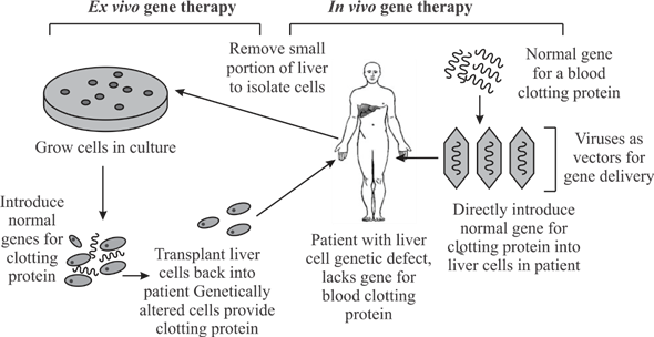 Gene therapy is the usage of genes as therapeutic agents to alleviate or cure disease symptoms. It is a method in which attaining an ideal outcome is the goal. This cannot be done by drug treatments alone, which only control the symptoms of genetic disorders. The gene containing the correct sequence of DNA for a particular protein; called therapeutic gene, is inserted into a patient's cells to correct genetic disease conditions caused by faulty or missing genes. This method tries to achieve the goal of being the best method of translational medicine by first identifying a disease causing gene found by a scientific discovery, then translating the finding to an effective therapy and thus finally moving to a patient's bedside from the laboratory bench in order to treat a disease. Two main essential criteria for gene therapy are: ▪Identification of the gene or genes which are involved in causing the disease. ▪Cloning or synthesis of the gene in the laboratory. In the past, major targets of gene therapy were blood disorders like hemophilia, leukemia, etc. as it is relatively easy to make changes to blood cells outside the body and then return them back rather than treating cells of the cardiac or skeletal muscle or other organs with heterogenous cell populations. Currently, gene therapy approaches are being investigated for treatment of neurodegenerative diseases including Parkinson and Alzheimer disease, hereditary blindness, a variety of cancers, drug and alcohol addiction, depression, etc. There are two broad ways of treating a patient with gene therapy: 1. Ex vivo gene therapy In this therapy, some cells from the person with a particular genetic condition are removed. These cells are then treated in the laboratory in such a way that the newly inserted normal copy of therapeutic gene or DNA or RNA sequence inhibits the expression of protein secreted by the defective gene. After analyzing the expression of therapeutic gene in the laboratory, these cells are transplanted back into the person where the therapeutic gene expresses normal copies of the protein which is required by the body. No fear of immune system rejecting the altered cells is there, as the cells were initially derived from the person itself. 2. In vivo gene therapy In this therapy, therapeutic gene is directly introduced into the cells having faulty or missing genes without removing them from the patient's body. One of its major challenges is that it gets difficult to restrict the delivery of the therapeutic genes to only the planned tissues and not to all tissues in the body.   Fig. 1: ex vivo and in vivo gene therapy for a person suffering with a liver disorder.