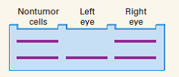 DNA from cells of a patient with retinoblastoma was analyzed using a Southern blot with a probe for a particular restriction fragment in the RB1 gene. The result from nontumor cells and the results from cells taken from a tumor in each eye are shown in the accompanying diagram. (a) Which band should be associated with the mutant allele and which with the nonmutant allele? (b) How is it possible for the bands from the tumor in the left eye to be different from those from the tumor in theright eye? (c) Explain how cells in the tumor in the right eye can have a loss of heterozygosity even though the bands are indistinguishable from those observed from nontumor cells.