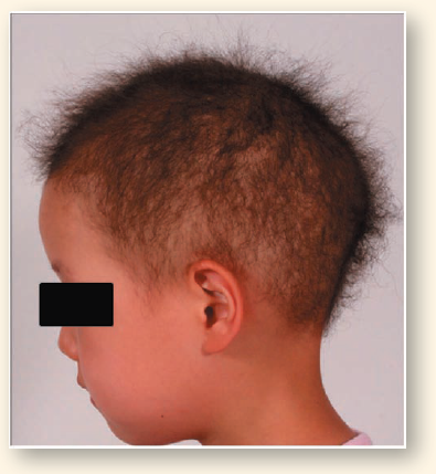 Why Woolly Hair Runs in Families  The boy in the photo on the right does not cut his hair. His hair breaks off naturally as it grows, keeping it from getting long. Other members of his family have the same sort of hair, suggesting it is a hereditary trait. Because of its curly, fuzzy texture, this trait has been given the name woolly hair. While the woolly hair trait is rare, it flares up in certain families. The extensive pedigree below (drawn curved to fit the large families produced by the second and subsequent generations) records the incidence of woolly hair in five generations (indicated by the Roman numerals on the left) of a Norwegian family. As is the convention, affected individuals are indicated by solid symbols, with circles indicating females and squares indicating males. The pedigree will provide you with all the information you need to discover how this trait is inherited within human families.      Drawing Conclusions  a. How many copies of the woolly hair allele are necessary to produce a detectable change in a person's hair? b. Are there any woolly hair homozygous individuals in the pedigree? Explain.