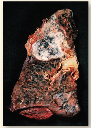 How Strong Is the Association Between Smoking and Lung Cancer? About a third of all cases of cancer in the United States are directly attributable to cigarette smoking. The association between smoking and cancer is particularly striking for lung cancer. The lung you see in the photograph below, riddled with cancer, is that of a smoker. A cancerous tumor has almost completely taken over the top half, and the black discoloration is due to tars. Cancer cells can migrate from the lungs into the lymph and blood vessels, and spread through the body. Many victims of lung cancer die of secondary tumors that form in other parts of the body, such as the brain. Over half a million people will die of cancer in the United States in 2015; about 27% of them will die of lung cancer. All Americans die. The tragedy of this statistic is that so many die unnecessarily soon-fully 87% of the lung cancer deaths were cigarette smokers. Smoking is a popular pastime among Americans. In the United States, 18% of adults and 14% of teens smoked in 2012. The smoke emitted from these cigarettes contains some 3,000 chemical components, including vinyl chloride, benzo[ a ]pyrenes, and N-nitrosonornicotine, all potent mutagens. Smoking places these mutagens into direct contact with the tissues of the lungs, with cancer as the potential result. How strong is the correlation between the number of cigarettes smoked per day and the incidence of lung cancer? To find out, a detailed study was made of the incidence of lung cancer among American men and of the cigarettes smoked per day. The results are presented in the graph above.     Interpreting Data a. If the incidence of cancer per 100,000 men is 100, what is the percent of men with cancer? b. Do you see a trend in the magnitude of the error bars in the graph? What might account for this?<div style=padding-top: 35px> 