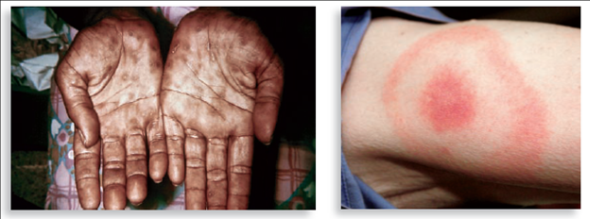 Identification of a unique skin rash can often be the first step in diagnosing a disease. What infectious agents are indicated by the rashes below?