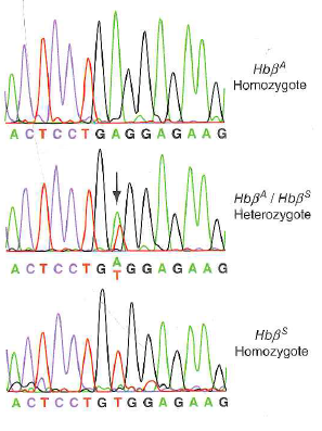 You sequence a PCR product amplified from a person's genome, and you see a double peak such as that seen in Fig. 10.11b. Most of the time, this result indicates that the person is a heterozygote for a SNP at that position. But it is also possible that the result is due to a mistake in DNA replication during the PCR amplification, with DNA polymerase misincorporating the wrong nucleotide. a. If you saw a double peak in the sequence trace, did the mistake happen in the first few rounds of PCR amplification or in the last few rounds b. Whether or not you see a double peak, is it more likely that a mistake would happen in the first few rounds of PCR amplification or in the last few rounds c. Given that mistakes can happen during PCR amplification, what could you do to ever be sure of a person's genotype Why would this degree of certainty be difficult to achieve if you were doing preimplantation genotyping of embryos d. PCR relies on heat-stable DNA polymerases from thermophilic bacteria that grow in hot springs. The DNA polymerase originally used for PCR, from the bacterium Thermus aquaticus, lacks the 3 -to-5 exonuclease found in other DNA polymerases such as that from E. coli (review Fig. 7.9). Why do scientists now most often use DNA polymerase from a different thermophilic bacterium ( Pyrococcus furiosa ) that does contain this exonuclease function Figure 10.11 Detection of the sickle-cell mutation by sequencing of PCR products. (b) Sequencing of PCR products made using genomic DNA templates from individuals with normal and mutant alleles of this SNP locus. Note that the sequence of the PCR product from a heterozygous carrier shows both the normal ( Hb A ) and mutant ( Hb s ) nucleotides at the position of the substitution. (b) Genotyping for sickle-cell anemia   Figure 7.9 DNA polymerase's proofreading function. If DNA polymerase mistakenly adds an incorrect nucleotide at the 3 end of the strand it is synthesizing, the enzyme's 3 -to-5 exonuclease activity removes this nucleotide, giving the enzyme a second chance to add the correct nucleotide.  <div style=padding-top: 35px> 